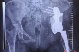 泰康同济完成一例骨盆恶性肿瘤手术，为防癌细胞扩散，患者左半侧骨盆被整体摘除图片