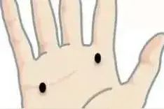 是黑痣？还是黑色素瘤？当心癌变！别拿黑痣不当回事！图片