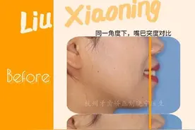 杭州牙齿矫正丨嘴凸可以戴舌侧牙套吗？矫正时间是不是快一些？图片