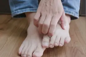 女孩脚气久治不愈，一查竟是梅毒所致！夏天，当心“梅毒”脚下起图片