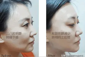 医生不会说的 | 做面部线雕几年后会变成什么样子？图片