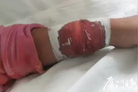 吓人！厦门19岁男子被眼镜蛇咬伤，送医抢救！“凶手”竟是自己养的宠物图片