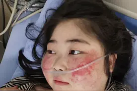 穿古装跳舞胖女孩住院！血小板变少全身出血，医生已下病危通知书图片