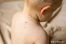 带状疱疹会传染给他人吗图片