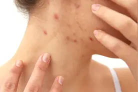 脸上长痘痘化脓怎么办？是有湿热瘀血，推荐一张祛湿化瘀小药方图片