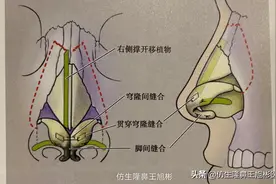 鼻尖夹捏畸形修复手术的原理是什么？图片
