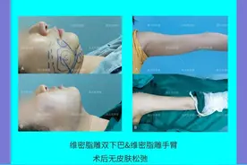 面部吸脂你真的都了解吗？来看看面部吸脂的常见问题解答图片