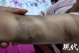 作业未完成，小学生被打得浑身淤青！涉事老师停职图片