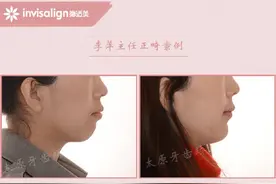 太原牙齿矫正｜关于骨性前突患者的矫正方式图片