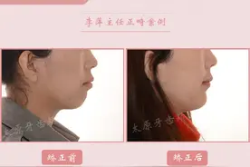太原牙齿矫正｜关于骨性前突患者的矫正方式图片