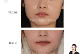 沈阳牙齿矫正：门牙前突矫正会改变脸型吗？图片