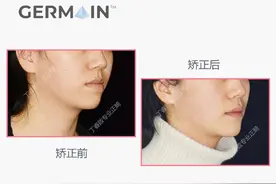 郑州隐适美：地包天改善病例分享图片