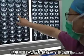 #健康中国行动2030# 罕见！男子天生巨型输尿管致肾萎缩图片
