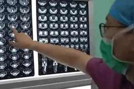 #健康中国行动2030# 罕见！男子天生巨型输尿管致肾萎缩图片