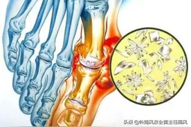 从高尿酸发展到痛风的两个条件，在生活中应如何避免？图片