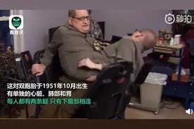 一生相依！世界上最长寿连体兄弟去世，有单独心脏仅下腹相连，享年68岁图片
