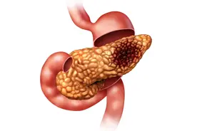 糖类抗原升高是患了胰腺癌吗？胰脏癌如何早发现？有哪些典型征兆图片