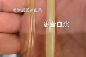 血脂降不下来？试试物理降脂，把血管里的“油”给吸出来图片