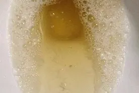 尿液中有泡沫是怎么回事？图片