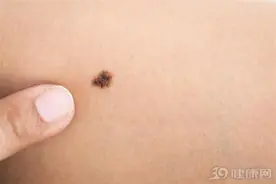 女子点痣半年后发生癌变，点痣还能不能做？皮肤科主任说出答案图片