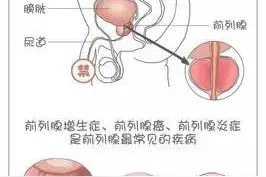 男科专家张广清：前列腺的5叶结构图片