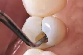 你的牙齿龋坏到这个程度，就不用补牙了图片