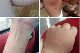 只因挠破蚊子包，4岁女童大腿坏死险丧命：被蚊子叮后的第一件事，99%家长都做错了！图片
