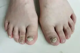及时治疗脚气，是对家人最好的负责图片