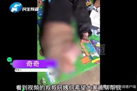 “我想自己站起来回去上学”男孩单腿重达40斤，似“大象腿”无法直立行走图片