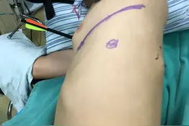 慎点！男子被箭射穿左胸，离心脏1厘米，还是自己射的图片