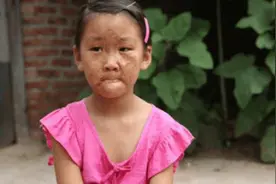 妈妈夺走女儿的脸，6岁女童渴望摘下“面具”，网友：可怕图片