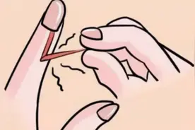 手上有倒刺怎么办？暴力撕扯有错吗？其实预防比较重要图片