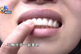 做全瓷牙后三次调整，感觉唇形受到影响图片