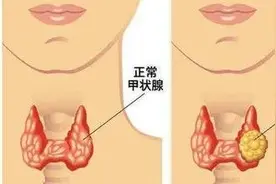 脖子两侧有突起，别紧张！甲状腺结节，了解一下图片