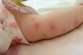 你还在给宝宝用这些成分的止痒神器吗？快住手图片