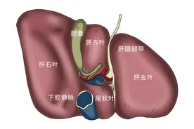 肝内钙化灶很严重吗？是不是说明离肝硬化不远了？图片