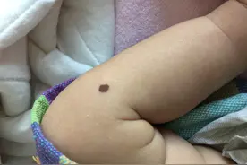 色素痣：一个5岁孩子的就诊经历图片