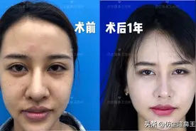 外切缩鼻翼会留疤吗？鼻翼整形都包括哪些项目图片