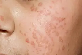 扁平疣是怎么造成的？有可能自愈吗？图片