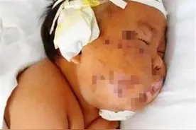 5年过去了，那个因吃奶太用力被妈妈用剪刀戳脸的男婴，现状如何图片