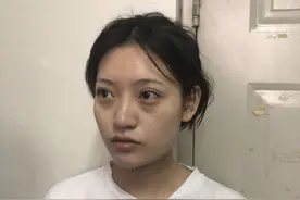 27岁的我隆鼻太焦虑，术后恢复让简直翻天覆地的变化，这波罪值了图片