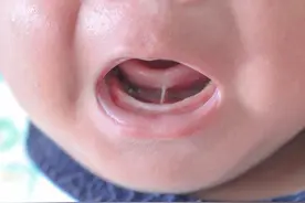 宝宝“舌筋短”，到底要不要剪？最佳处理时间是几岁？图片