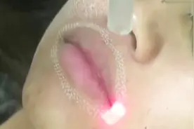 还在为长痘留疤痕所烦恼吗？可以来试试这个激光治疗法，一次见效视频封面