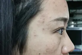 吐血三年“战痘”，停止在脸上折腾以后，皮肤再也没长过痘图片