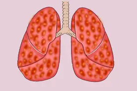 一个肺癌患者的自述：肺癌是如何折磨我的？我是如何成功抗癌的？图片