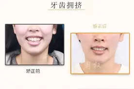 长沙牙齿矫正｜正畸合集：牙齿拥挤、龅牙、地包天、深覆合图片