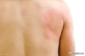 越挠越痒，夜间更痒，荨麻疹反反复复，彻底治愈难在哪里图片