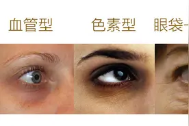 如何拯救让你崩溃又无可奈何的黑眼圈？分清类型才能对症有效！图片