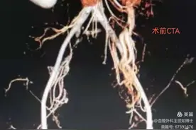 南大二附院王世知博士团队成功治愈一例盆腔淤血综合症患者图片