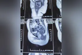 1岁女婴竟然来月经？专家：警惕阴道恶性肿瘤图片